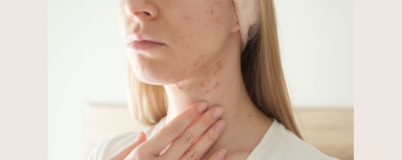Cause e rimedi dell'acne cistica