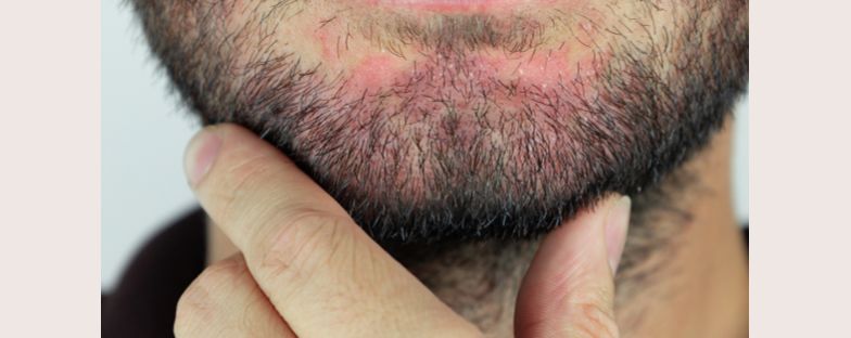 Cause e sintomi della dermatite seborroica al viso