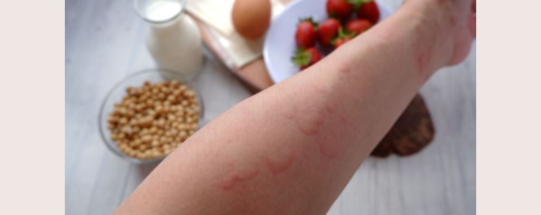 Allergie alimentari: cosa sono e come si curano  