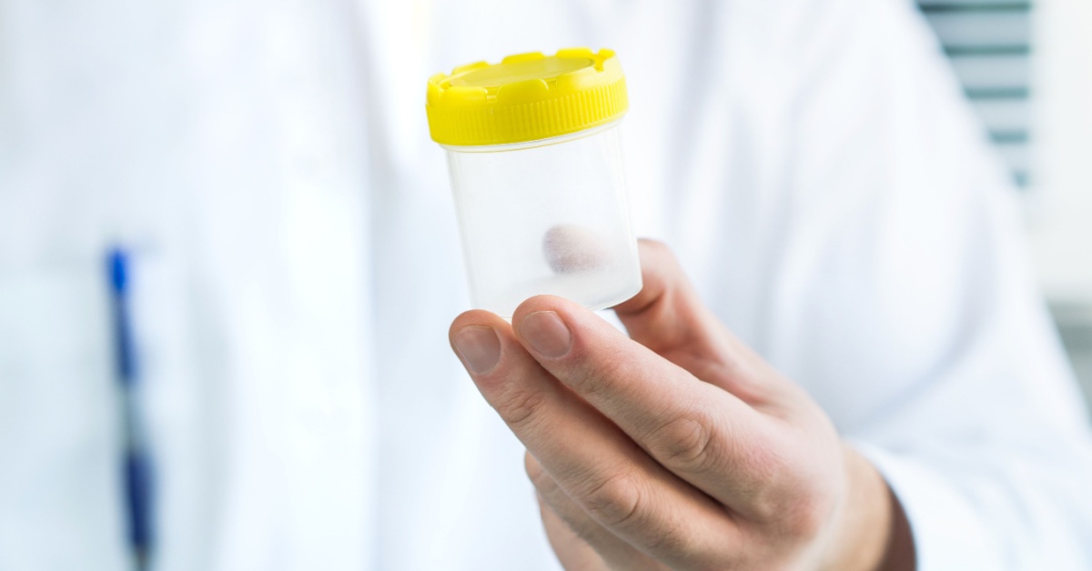 Sangue nelle urine: cause e cure