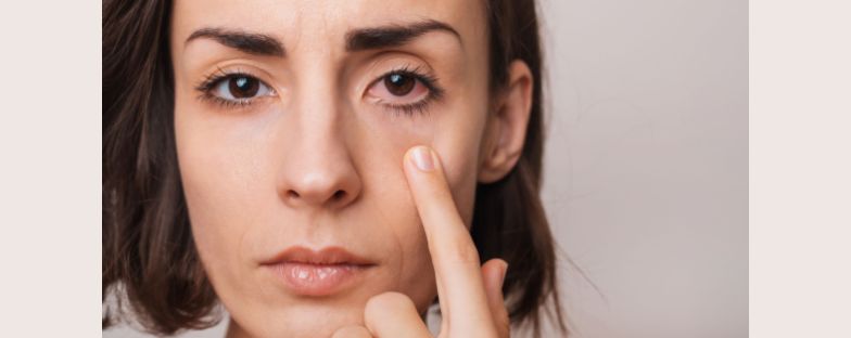 Allergia agli occhi: cos’è e come si cura  