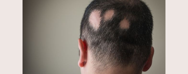 I nuovi trattamenti per la cura dell’alopecia