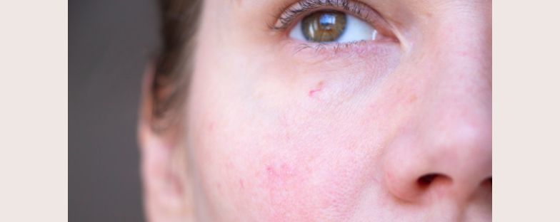 Laser vascolare: a cosa serve e come prepararsi 