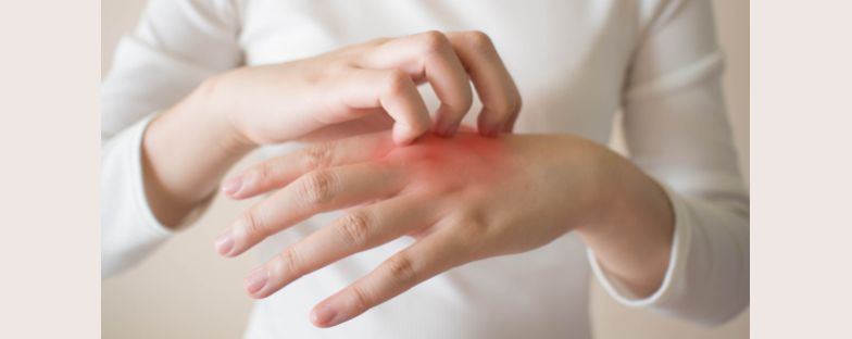 Eczema o dermatite da freddo: i consigli del dermatologo 
