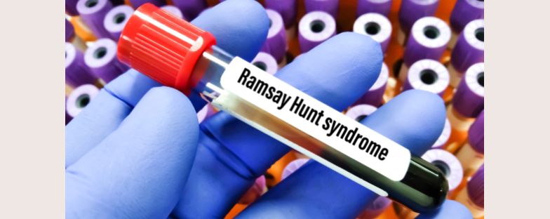 Sindrome di Ramsay Hunt: sintomi, cura e prevenzione