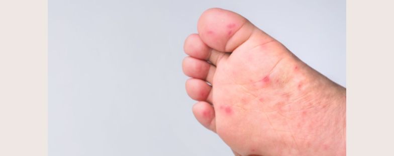 Cos'è la malattia ‘mani-piedi-bocca’ e come riconoscerla