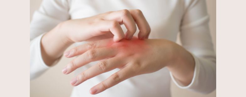Eczema: come riconoscerlo e curarlo 